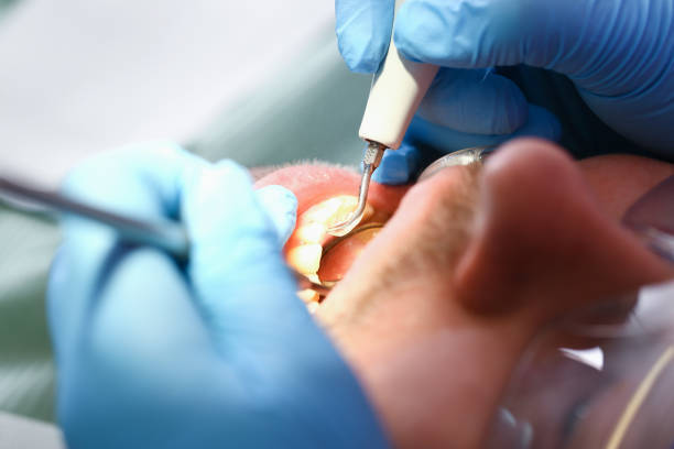 Best Dentist for Tooth Abscess  in West Vero Corridor, FL