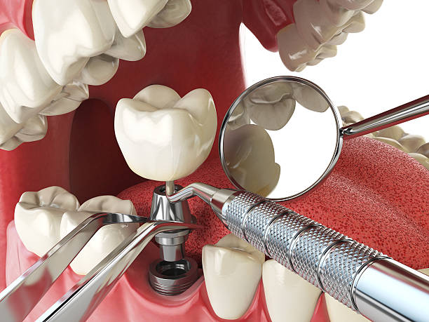 Best Knocked-Out Tooth Emergency  in West Vero Corridor, FL